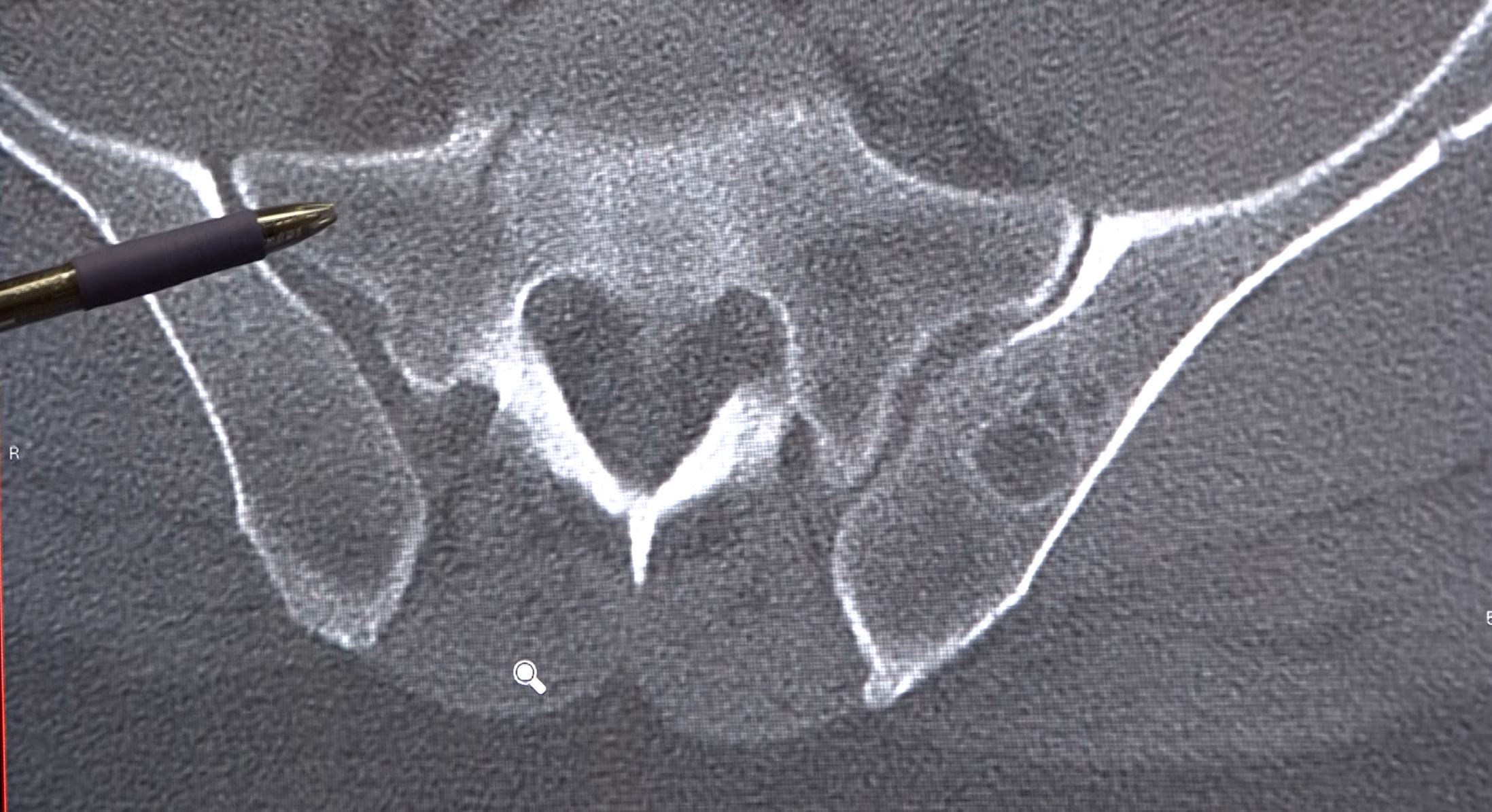 A grayscale CT scan image showing a transverse section of the pelvic region.