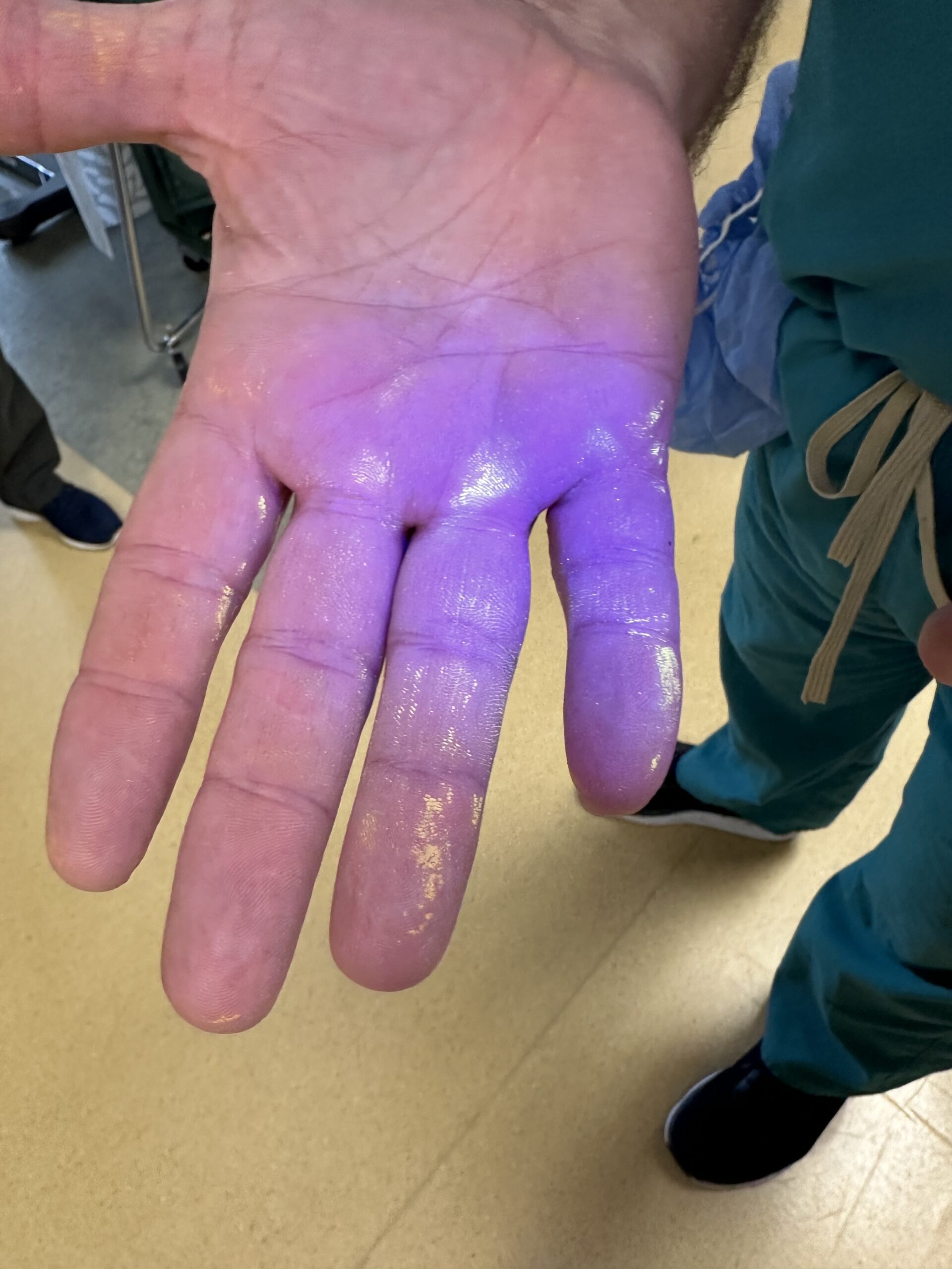 A person's hand with a purplish glow under UV light, highlighting areas of contamination. The person is wearing a green medical uniform.