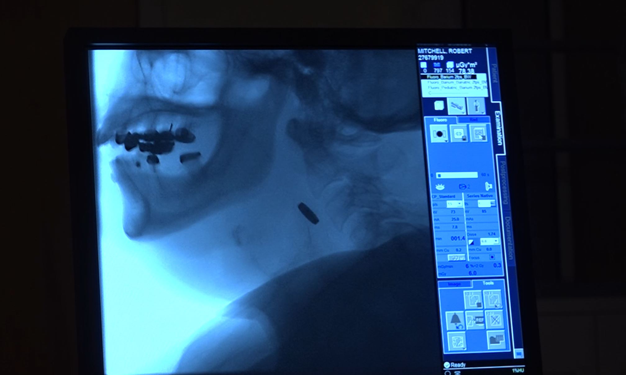 X-ray image displayed on a monitor, showing a profile view of a human skull and neck with visible dental hardware. Various settings and options are shown on the right side of the screen.