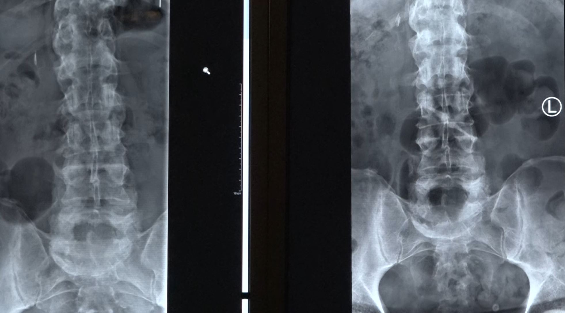 X-ray images showing two views of the lumbar spine, with visible vertebrae and soft tissues. The image on the left appears to have a small, opaque object.