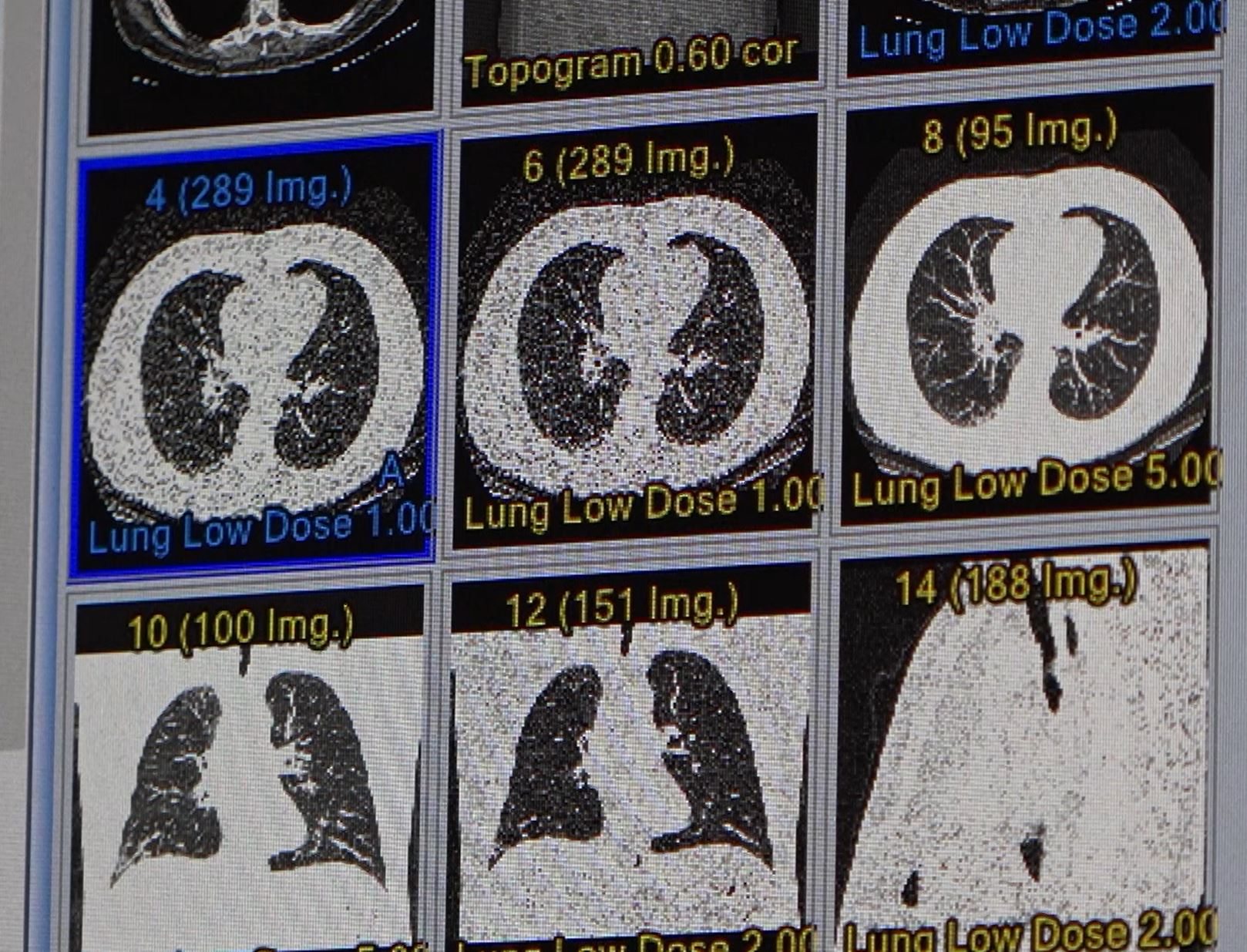 VIDEO: Estes Park Health offers low dose lung CT scans for lung cancer