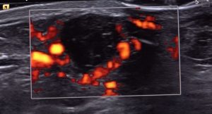 An ultrasound image showing a black circular area surrounded by red-orange patches within a rectangular overlay.