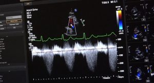 An ultrasound machine screen displays an echocardiogram with a heart valve measurement and a waveform graph.